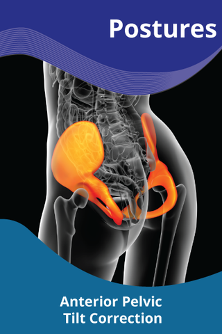 Anterior Pelvic Tilt Correction